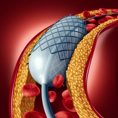 Angioplasty And Stent Concept clipart