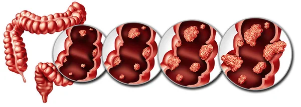 Colorectal Cancer Colon Disease Concept Medical Illustration Different Stages Cancers — 图库照片