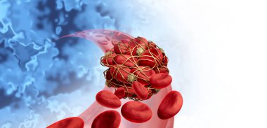 Blood clots health risk or thrombosis medical illustration concept symbol as a group of human blood cells clot clumped together by sticky platelets and fibrin as a blockage in an artery or vein as a 3D render. clipart