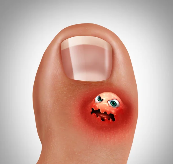 足部水泡或足部疣的概念 如玉米酸痛或足部疼痛 表示足部感染或足部受伤的3D图例 — 图库照片