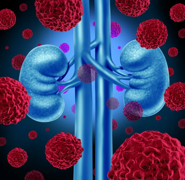 Cáncer renal — Foto de Stock