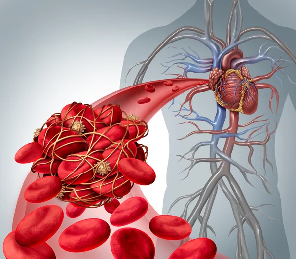 Blood Clot Risk — Stock Photo, Image