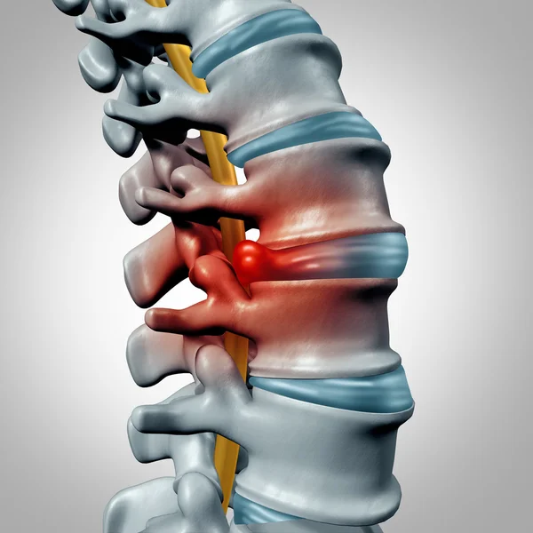 Herniated Disk Concept — 图库照片