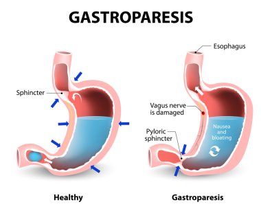 Gastroparesis or delayed gastric emptying clipart