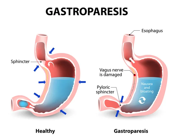 Gastroparesia o retraso en el vaciado gástrico — Vector de stock
