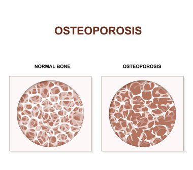 Osteoporoz. düşük tarafından karakterize hastalik kemik kitle