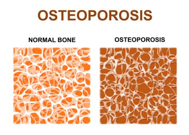 normal kemik ve kemik Osteoporoz ile