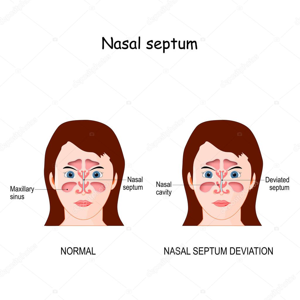 Nasal septum deviation. bone and cartilage in the nose that separates the nasal cavity into the two nostrils. difference and comparison of the nose with a normal and deviated septum