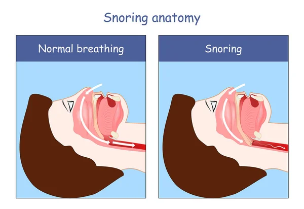 Snoring Anatomy Normal Breathing Snoring Air Open Obstructed Airways Cross — Stock Vector