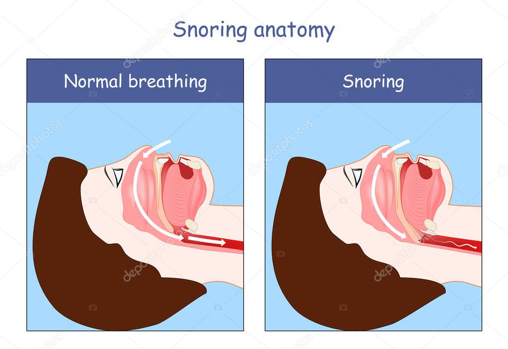 Snoring anatomy. Normal breathing and Snoring. air open and obstructed airways. Cross section of human's head, nose, mouth, trachea, and tongue.