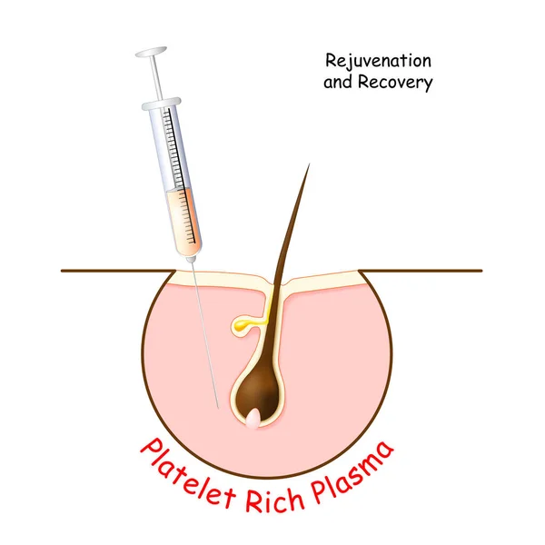 Plasma Platelet Yang Kaya Untuk Rejuvenasi Dan Pemulihan Kulit Dan - Stok Vektor