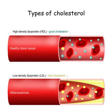 Kolesterol türleri. iyi (HDL) ve kötü (LDL) kolesterol. Sağlıklı kan damarı ve ateroskleroz. Kan damarlarının eritrositlerle, düşük yoğunluklu ve yüksek yoğunluklu lipoproteinlerle çapraz kesiti. Açıklama için vektör diyagramı Normal ve daraltılmış arter
