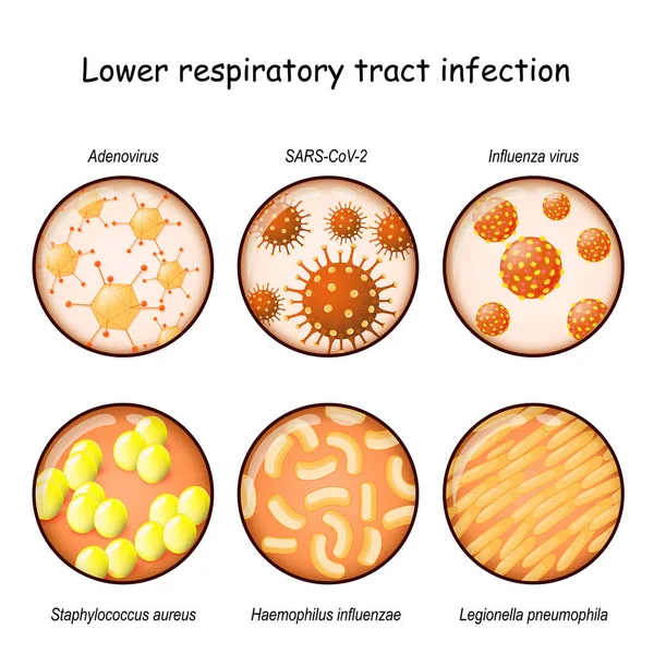 Solunum yolu enfeksiyonu. Zatürreenin nedensel etkenleri: Virüsler (Adenovirüs, Influenza virüsleri, SARS-CoV-2) ve bakteriler (Lejyonella pneumophila, haemophilus influenzae, Staphylococcus aureus). Hastalıklar hakkında vektör illüstrasyon 