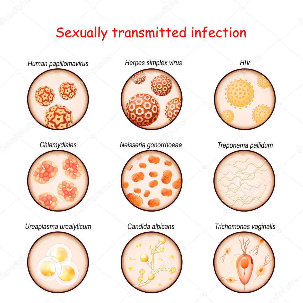 Infecci n de transmisi n sexual. Primer plano de los agentes causales ...