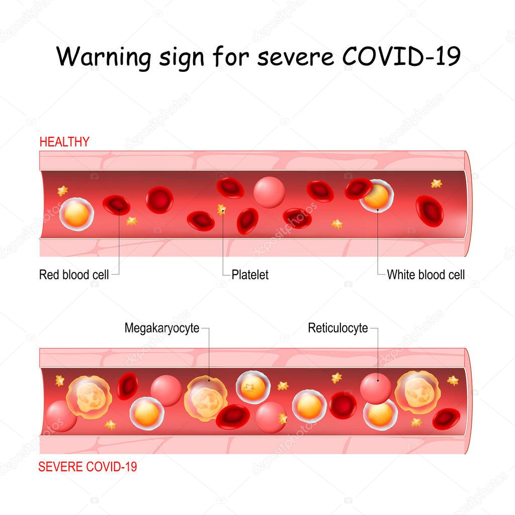COVID-19. Warning sign for severe acute respiratory syndrome coronavirus disease. detection of severe complications. two blood vessel. Normal and blood with Megakaryocyte, Reticulocyte, and a lot of Platelets