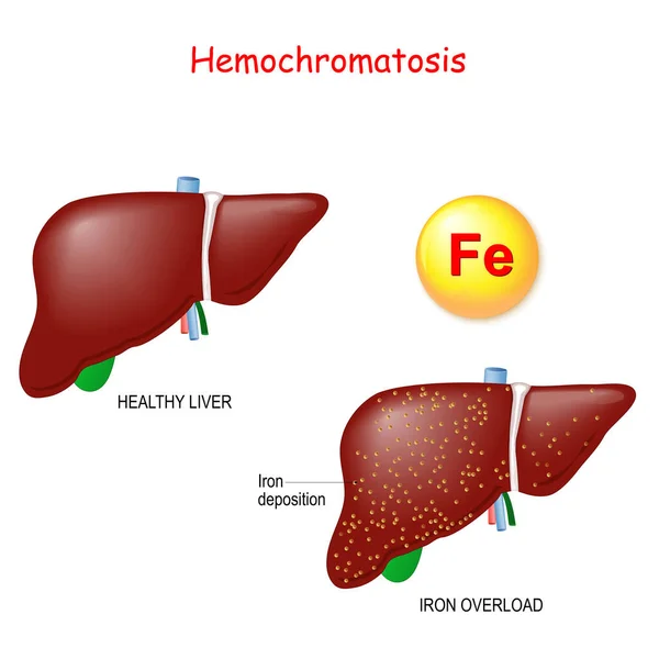 Hemocromatosis Sobrecarga Hierro Hígado Sano Hígado Con Depósitos Hierro Trastorno — Vector de stock