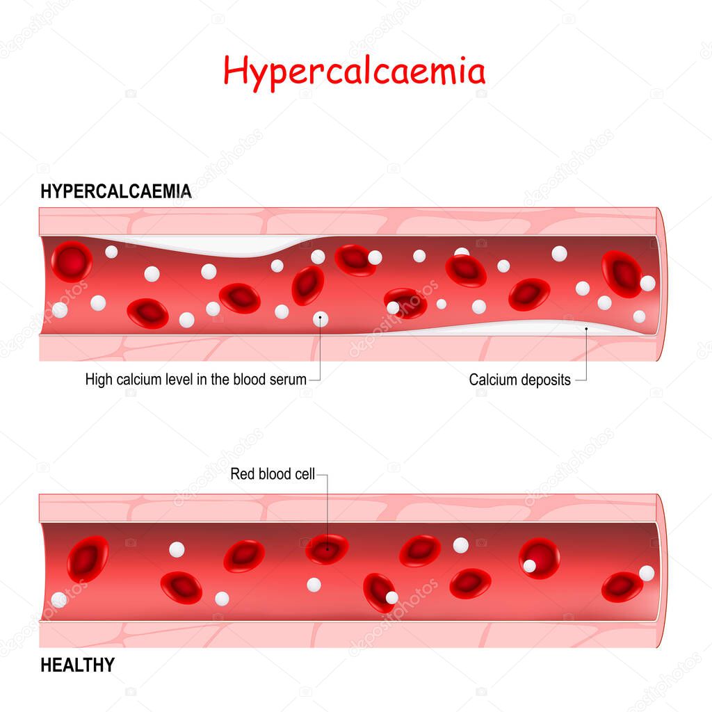 Hypercalcaemia. hypercalcemia is a high calcium level in the blood serum. Healthy blood vessel, and artery with Calcium deposits. comparison, and differences