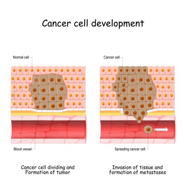 Cancer development from normal cell to Formation of tumor, Spreading cancer cells in blood flow, Invasion of other tissue, and formation of metastases. vector illustration