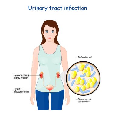 İdrar yolu enfeksiyonu. Sistit ve piyelonefrit. Böbrekleri ve mesanesi olan bir kadın. Bu hastalığa neden olan bakterilerin yakın çekimi: Staphylococcus saprophyticus ve Escherichia coli (E. coli)