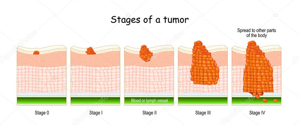 stages of cancer. Classification of Malignant Tumours (from 0 to 4). system that is most commonly used for the staging process of cancer 
