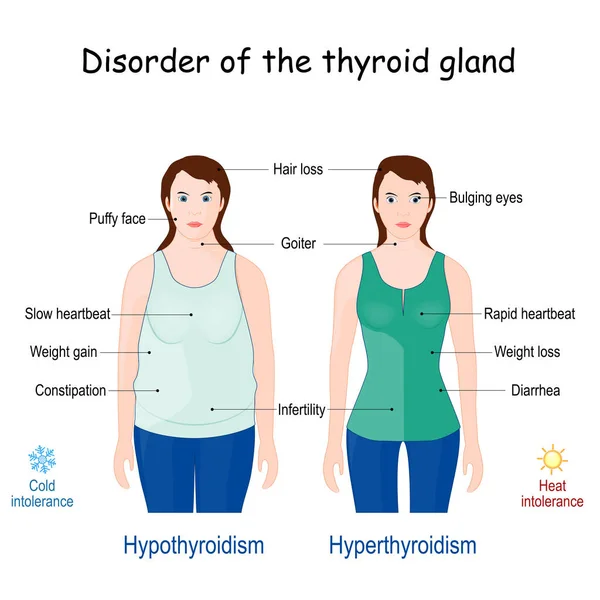 Alterações Glândula Tiróide Comparação Diferença Entre Hipertireoidismo Hipotireoidismo Sinais Sintomas — Vetor de Stock