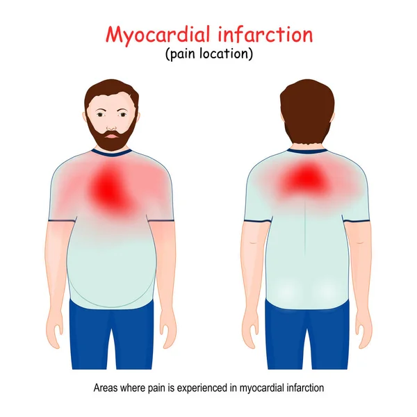 Infarctus Myocarde Crise Cardiaque Localisation Douleur Homme Les Zones Sur — Image vectorielle