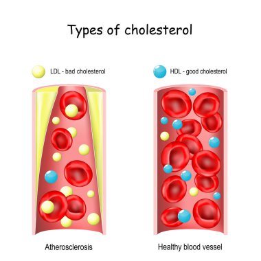 İyi ve kötü kolesterol. HDL ve LDL lipoprotein karşılaştırması. Sağlıklı ve daralmış arter (Atherosclerosis). Çapraz. vektör illüstrasyonu