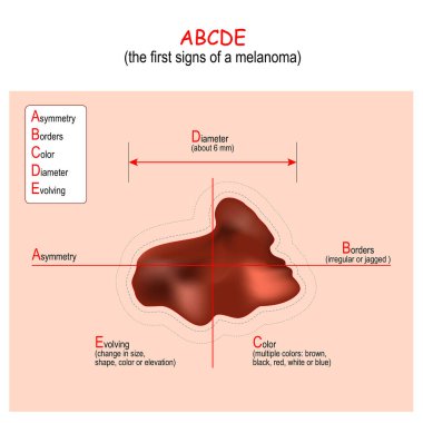 Melanomanın erken tespiti için ABCDE Kuralı. Cilt kanseri belirtileri ve belirtileri. Kötü huylu tümör ve benler. Vektör illüstrasyonu