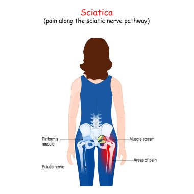 Sciatica. pain along the sciatic nerve pathway from lower back through hips to leg. Body of a patient (woman) with areas of pain from the back. Piriformi