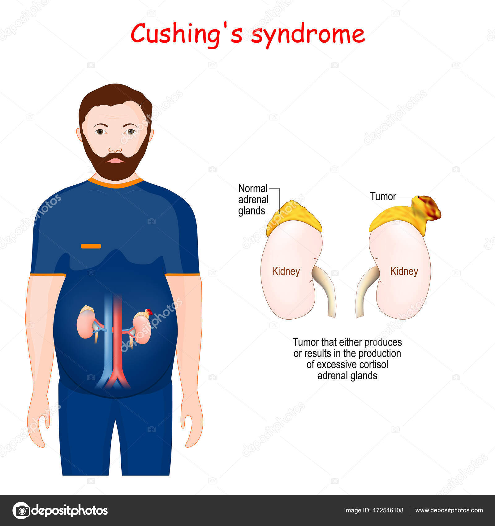 Cushing's Syndrome Male Silhouette Highlighted Kidneys Close Normal Suprarenal Gland Stock