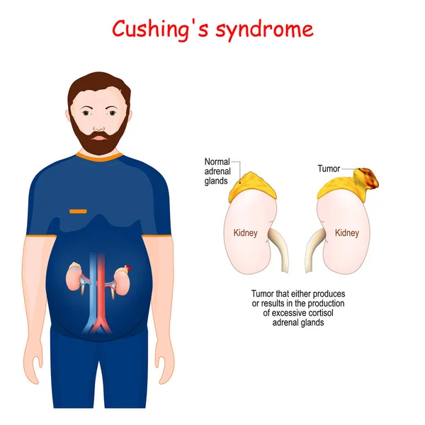 Sindrome Cushing Silhouette Maschile Con Reni Evidenziati Primo Piano Della — Vettoriale Stock