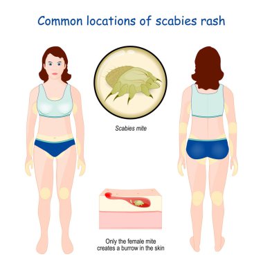 Yaygın kaşıntı yerleri var. Scabies Mite 'a yakın çekim. Deri tabakalarının çapraz kesitlerinin büyütülmesi. Dişi akarsular deride bir oyuk oluşturur. Bilgi aktarımı. Vektör illüstrasyonu