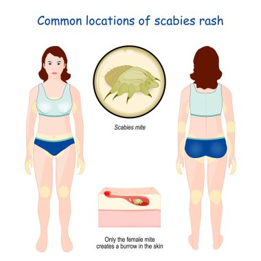 Common locations of scabies rash. Close-up of Scabies mite. Magnification of cross section of skin layers. female mite that creates a burrow in the skin. infographic. Vector illustration clipart