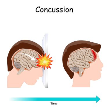 Concussion. Human's head. brain after head trauma. Vector illustration clipart