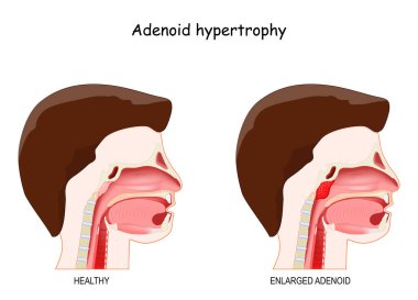 Adenoid hipertrofi. İnsan kafasının kesiti sağlıklı ve iltihaplanmış adenoidlerle dolu. vektör illüstrasyonu