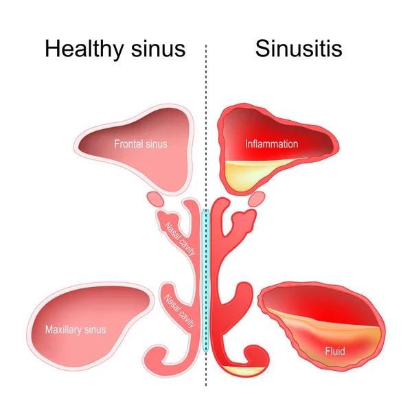 Sinusitis Gezonde Neusholte Sinus Met Infectie Ontsteking Vocht Vectorillustratie — Stockvector