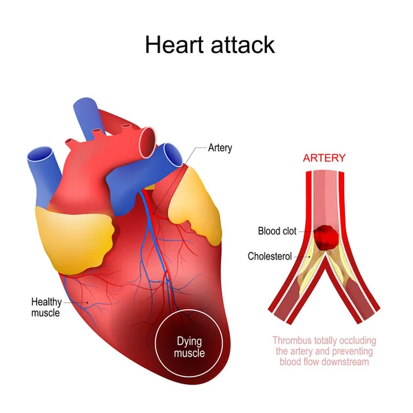 Crise Cardiaque Infarctus Myocarde Coeur Humain Avec Muscle Mourant Gros — Image vectorielle