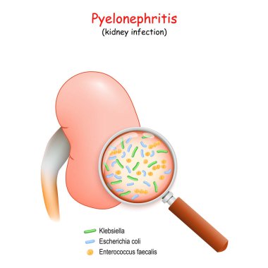 Pyelonefrit. Böbrek enfeksiyonu Büyüteç. Bakteriye yakın çekim: Klebsiella, Escherichia coli, Enterococcus faecalis. Vektör çizimi. tıbbi Poster