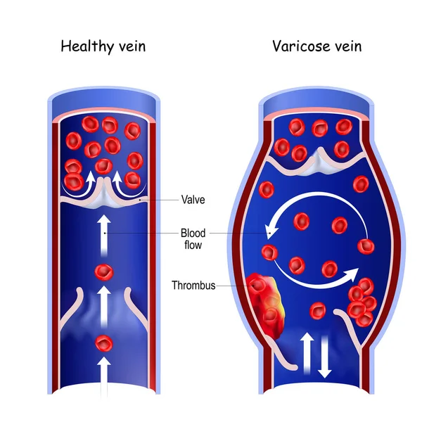 Vena Sana Vena Varicosa Sezione Trasversale Del Vaso Sanguigno Normale — Vettoriale Stock