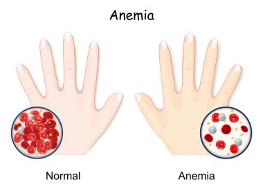 Anemia. hand of healthy human and anaemia. decrease in the total amount of red blood cells. Close-up of normal blood and RBCs of anemia. hemoglobin in the blood. comparison and difference  clipart