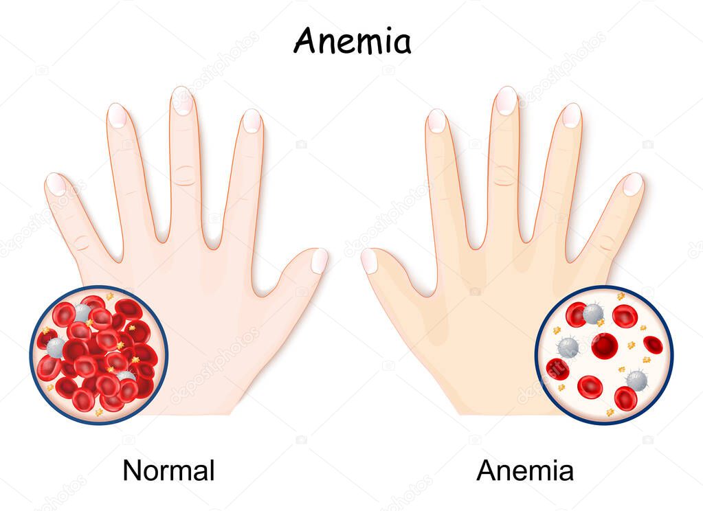 Anemia. hand of healthy human and anaemia. decrease in the total amount of red blood cells. Close-up of normal blood and RBCs of anemia. hemoglobin in the blood. comparison and difference 