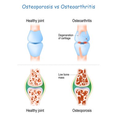 Osteoporoz, Osteoartrit 'e karşı. Sağlıklı eklem ve dejeneratif eklem hastalığı ile kemik kütlesi düşük eklem arasındaki fark ve karşılaştırma. İskelet kemiğinin kesiti