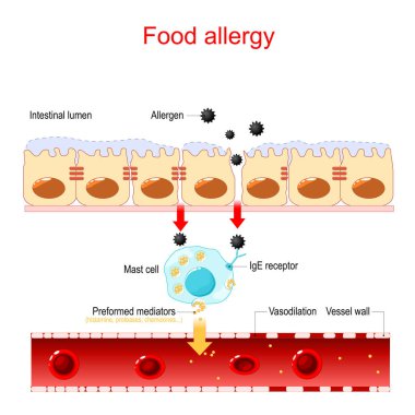 Food allergy and leaky gut. abnormal immune response to food. Vector illustration clipart