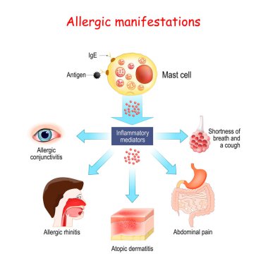 Gıda alerjisi ve alerjik belirtiler. Mast hücresi ve kışkırtıcı arabulucular. Alerjik konjonktivit, atopik dermatit, alerjik rhtis. Vektör illüstrasyonu. 