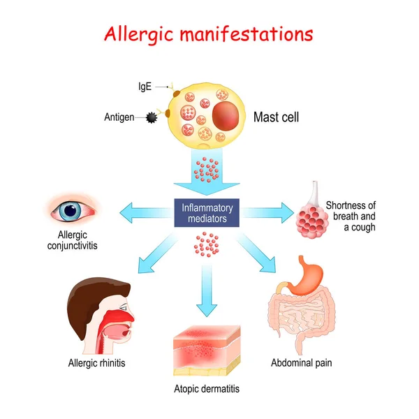 Nahrungsmittelallergie Und Allergische Manifestationen Mastzellen Und Entzündungsmediatoren Allergische Bindehautentzündung Neurodermitis — Stockvektor