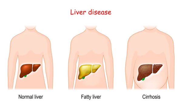 Liver Diseases Stages Liver Damage Healthy Fatty Cirrhosis Human Body — Stock Vector