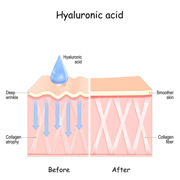 ヒアルロン酸 ヒアルロン酸の使用前と後の皮膚 美容整形後のコラーゲン萎縮とディープしわとスムーズな肌の比較と違い — ストックベクタ