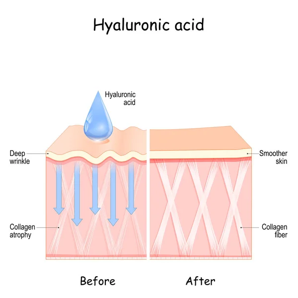 Hyaluronsyra Använd Före Och Efter Hyaluronsyra Jämförelse Och Skillnad Mellan — Stock vektor