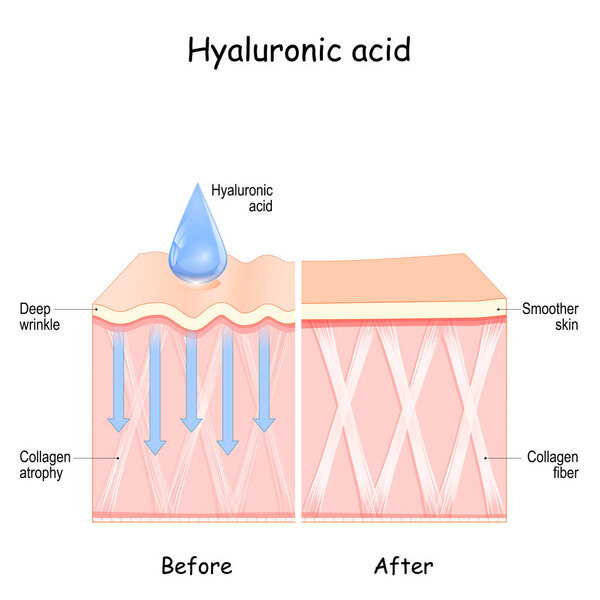 Hyaluronic acid. skin Before and After Hyaluronic acid use. comparison and difference between skin with  Collagen atrophy and Deep wrinkles and  Smoother skin after cosmetic procedure