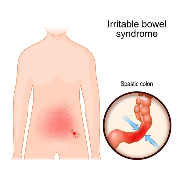 Sinirli Bağırsak Sendromu Ibs Mukolit Fonksiyonel Bir Gastrointestinal Bozukluktur Karın — Stok Vektör